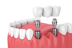 Diagram of the four steps of the dental implant process in Fort Lauderdale