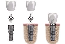 Diagram showing the abutment step of the dental implant process