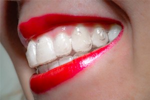 Smiling woman with red lipstick wearing Invisalign clear aligner in Fort Lauderdale