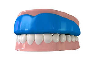 Model of an athletic mouthguard protecting teeth